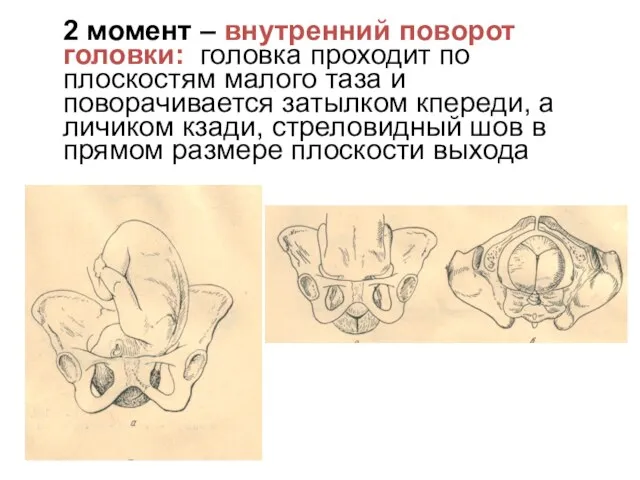 2 момент – внутренний поворот головки: головка проходит по плоскостям малого таза