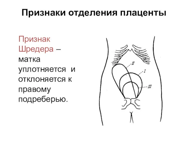 Признаки отделения плаценты Признак Шредера – матка уплотняется и отклоняется к правому подреберью.