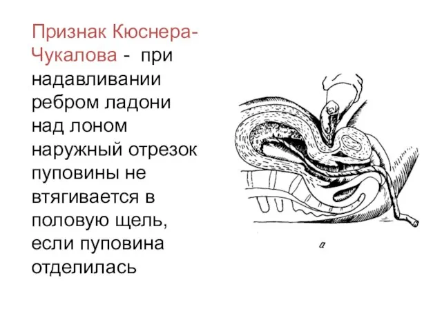 Признак Кюснера-Чукалова - при надавливании ребром ладони над лоном наружный отрезок пуповины