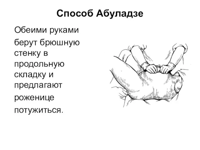 Способ Абуладзе Обеими руками берут брюшную стенку в продольную складку и предлагают роженице потужиться.