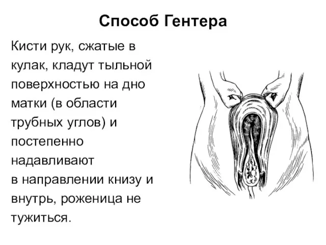 Способ Гентера Кисти рук, сжатые в кулак, кладут тыльной поверхностью на дно