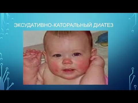 ЭКСУДАТИВНО-КАТОРАЛЬНЫЙ ДИАТЕЗ