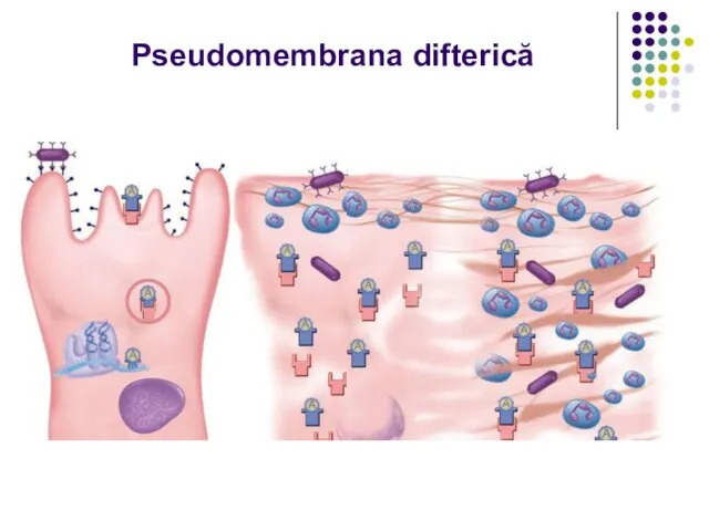 Pseudomembrana difterică