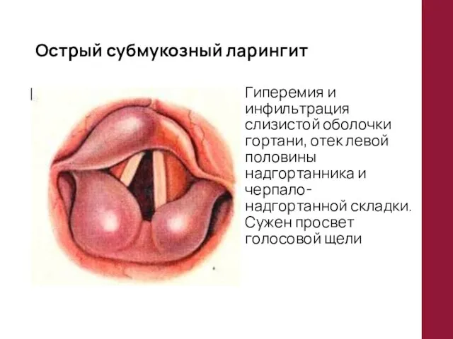Острый субмукозный ларингит Гиперемия и инфильтрация слизистой оболочки гортани, отек левой половины