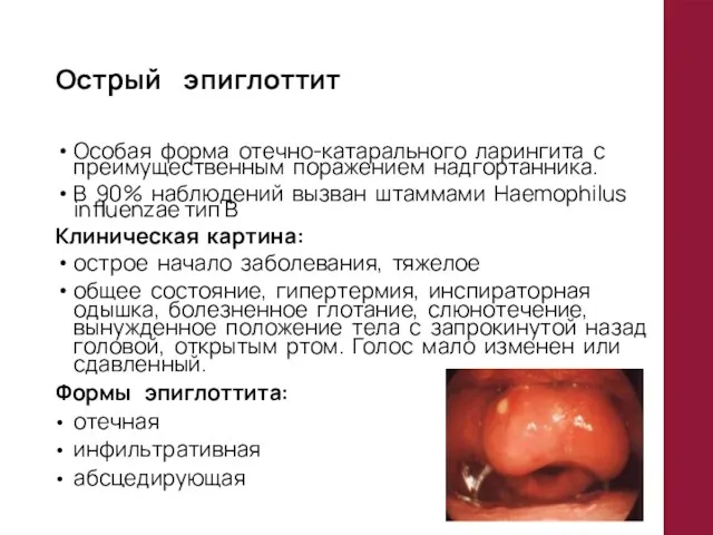 Особая форма отечно-катарального ларингита с преимущественным поражением надгортанника. В 90% наблюдений вызван