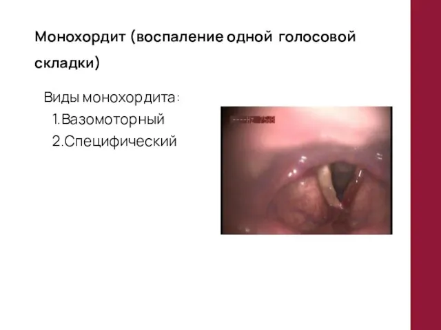 Монохордит (воспаление одной голосовой складки) Виды монохордита: 1.Вазомоторный 2.Специфический