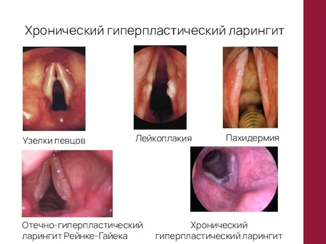 Хронический гиперпластический ларингит Узелки певцов Отечно-гиперпластический ларингит Рейнке-Гайека Лейкоплакия Пахидермия Хронический гиперпластический ларингит