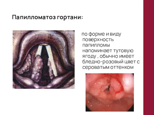 Папилломатоз гортани: по форме и виду поверхность папилломы напоминает тутовую ягоду ,