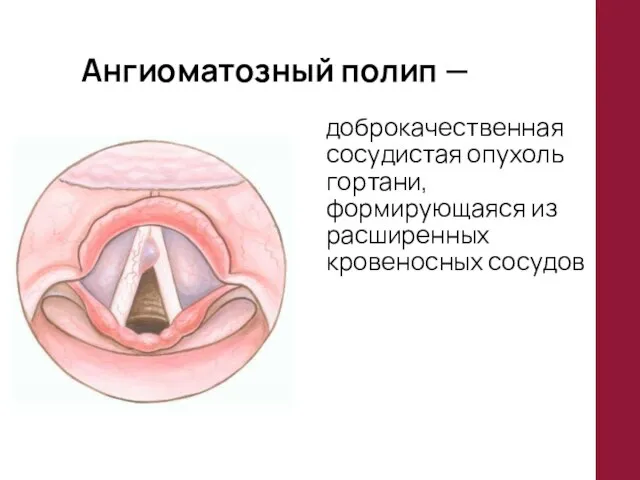 Ангиоматозный полип — доброкачественная сосудистая опухоль гортани, формирующаяся из расширенных кровеносных сосудов