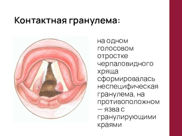 Контактная гранулема: на одном голосовом отростке черпаловидного хряща сформировалась неспецифическая гранулема, на