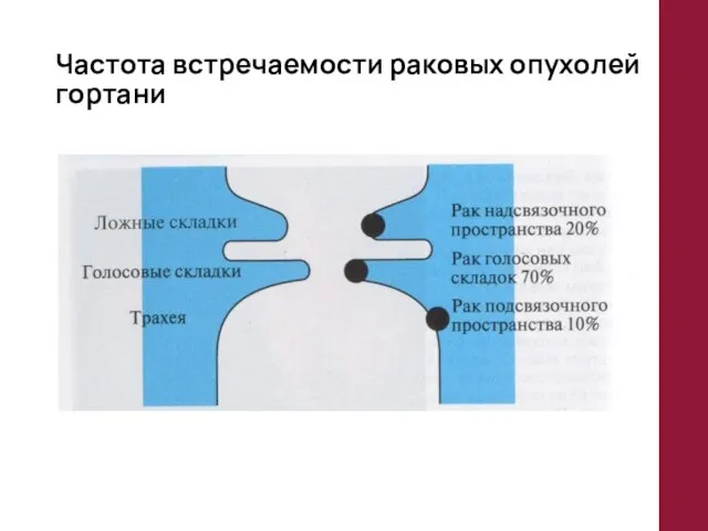 Частота встречаемости раковых опухолей гортани