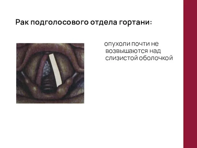 Рак подголосового отдела гортани: опухоли почти не возвышаются над слизистой оболочкой