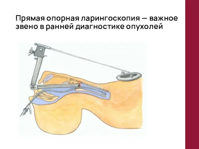 Прямая опорная ларингоскопия — важное звено в ранней диагностике опухолей