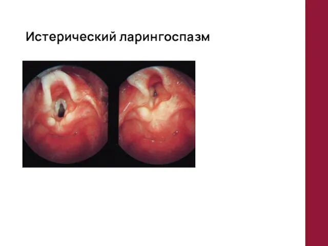 Истерический ларингоспазм