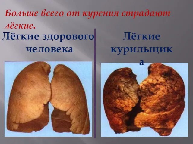 Лёгкие здорового человека Лёгкие курильщика Больше всего от курения страдают лёгкие.