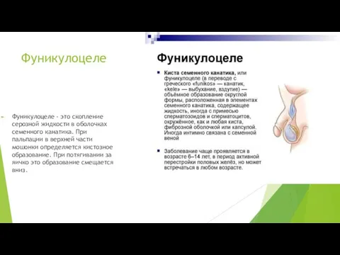 Фуникулоцеле Фуникулоцеле - это скопление серозной жидкости в оболочках семенного канатика. При