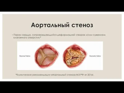 Аортальный стеноз Порок сердца, сопровождающийся деформацией створок и/или сужением клапанного отверстия.* *Клинические