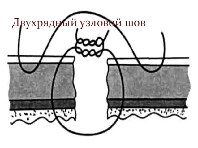 Двухрядный узловой шов