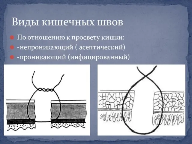 По отношению к просвету кишки: -непроникающий ( асептический) -проникающий (инфицированный) Виды кишечных швов