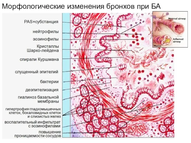 Морфологические изменения бронхов при БА