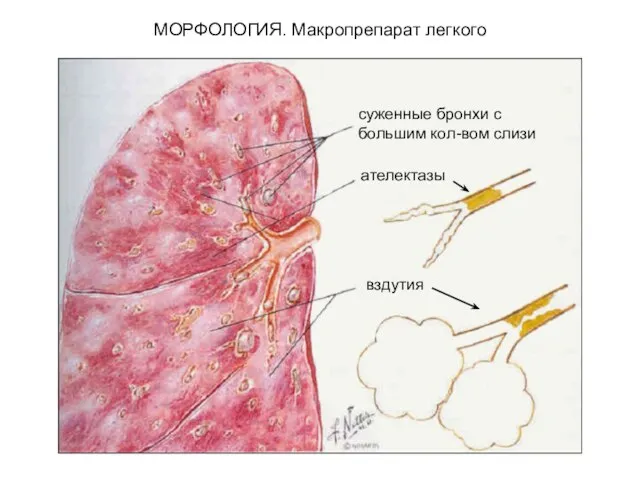 суженные бронхи с большим кол-вом слизи ателектазы вздутия МОРФОЛОГИЯ. Макропрепарат легкого