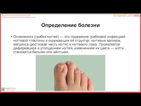 Определение болезни Онихомикоз (грибок ногтей) — это поражение грибковой инфекцией ногтевой пластины