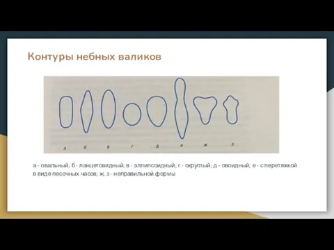 Контуры небных валиков а - овальный; б - ланцетовидный; в - эллипсоидный;