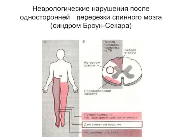 Неврологические нарушения после односторонней перерезки спинного мозга (синдром Броун-Секара)