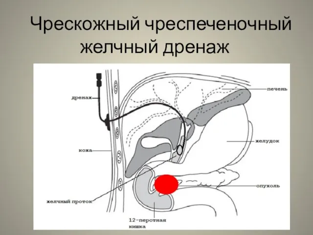 Чрескожный чреспеченочный желчный дренаж