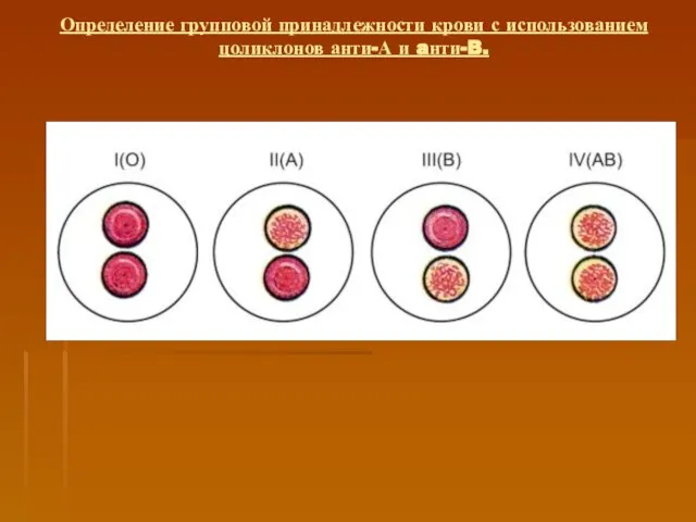 Определение групповой принадлежности крови с использованием цоликлонов анти-А и aнти-B.