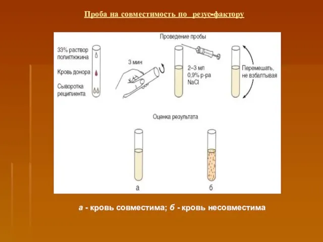 Проба на совместимость по резус-фактору а - кровь совместима; б - кровь несовместима