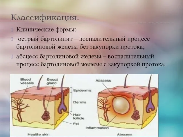 Классификация. Клинические формы: острый бартолинит – воспалительный процесс бартолиновой железы без закупорки