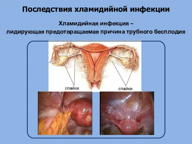 Последствия хламидийной инфекции Хламидийная инфекция – лидирующая предотвращаемая причина трубного бесплодия