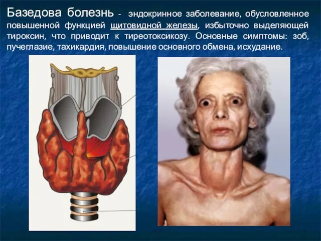 Базедова болезнь - эндокринное заболевание, обусловленное повышенной функцией щитовидной железы, избыточно выделяющей