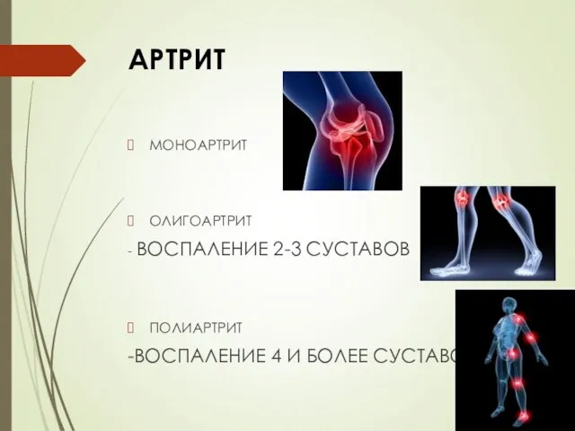 АРТРИТ МОНОАРТРИТ ОЛИГОАРТРИТ - ВОСПАЛЕНИЕ 2-3 СУСТАВОВ ПОЛИАРТРИТ -ВОСПАЛЕНИЕ 4 И БОЛЕЕ СУСТАВОВ