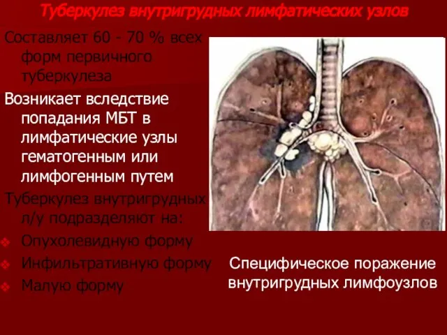 Туберкулез внутригрудных лимфатических узлов Составляет 60 - 70 % всех форм первичного