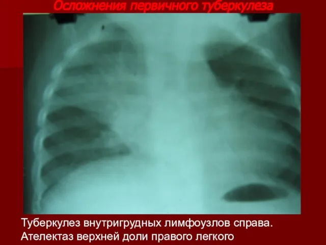 Осложнения первичного туберкулеза Туберкулез внутригрудных лимфоузлов справа. Ателектаз верхней доли правого легкого