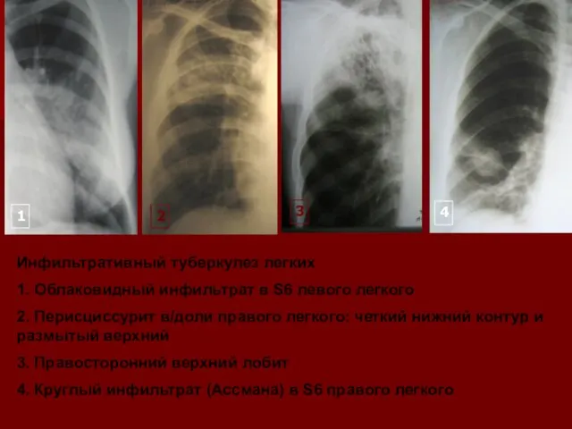 Инфильтративный туберкулез легких 1. Облаковидный инфильтрат в S6 левого легкого 2. Перисциссурит