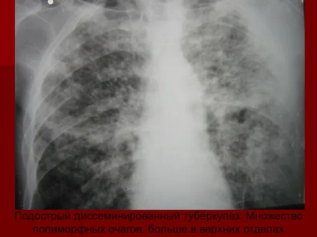 Подострый диссеминированный туберкулез. Множество полиморфных очагов, больше в верхних отделах