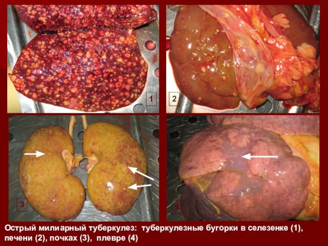 Острый милиарный туберкулез: туберкулезные бугорки в селезенке (1), печени (2), почках (3),