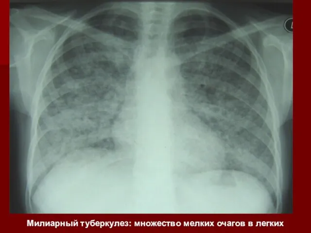 Милиарный туберкулез: множество мелких очагов в легких