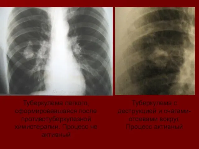 Туберкулема с деструкцией и очагами-отсевами вокруг. Процесс активный Туберкулема легкого, сформировавшаяся после