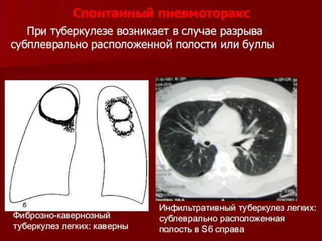 Спонтанный пневмоторакс При туберкулезе возникает в случае разрыва субплеврально расположенной полости или