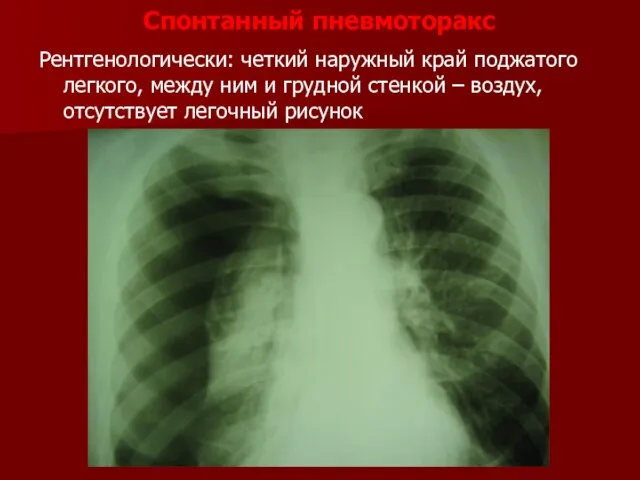 Рентгенологически: четкий наружный край поджатого легкого, между ним и грудной стенкой –