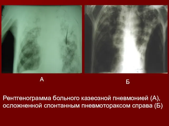 Рентгенограмма больного казеозной пневмонией (А), осложненной спонтанным пневмотораксом справа (Б) А Б