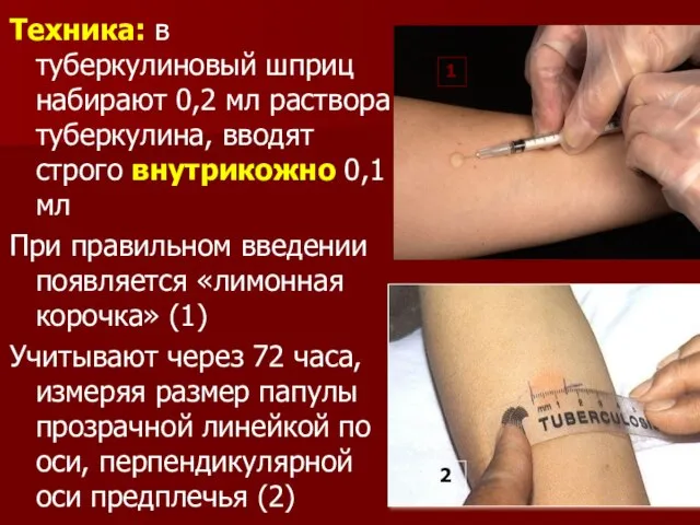 Техника: в туберкулиновый шприц набирают 0,2 мл раствора туберкулина, вводят строго внутрикожно