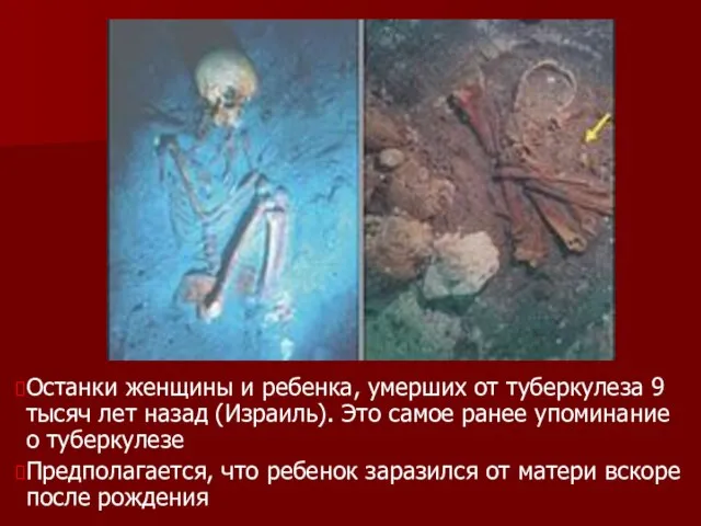 Останки женщины и ребенка, умерших от туберкулеза 9 тысяч лет назад (Израиль).