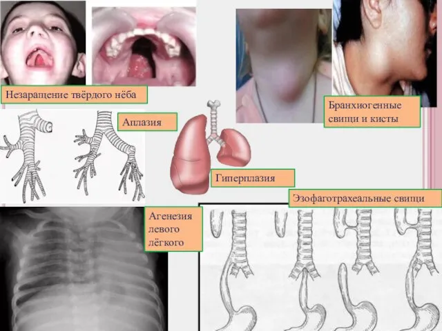 Незаращение твёрдого нёба Эзофаготрахеальные свищи Бранхиогенные свищи и кисты Агенезия левого лёгкого Аплазия Гиперплазия