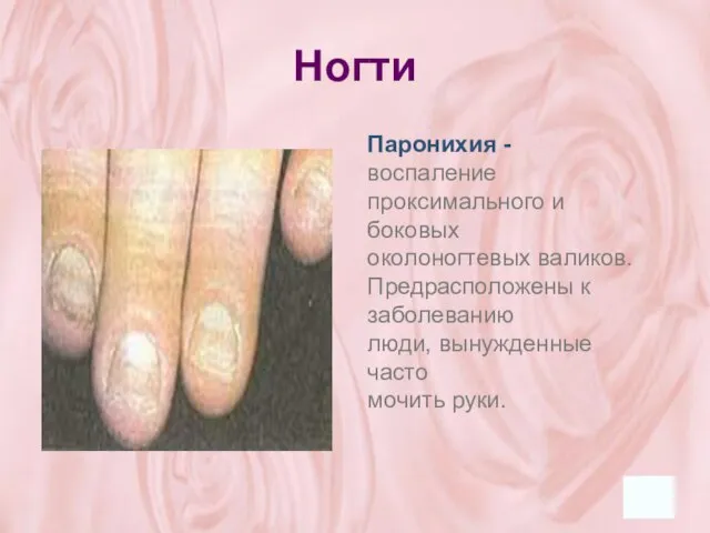 Ногти Паронихия - воспаление проксимального и боковых околоногтевых валиков. Предрасположены к заболеванию