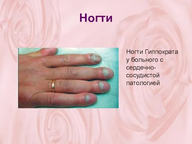 Ногти Ногти Гиппократа у больного с сердечно-сосудистой патологией